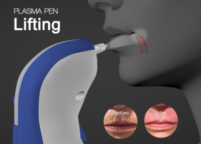 Plasma fine lines removal pen