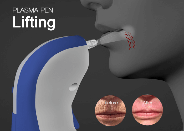 plasma lift pen 2nd generation technique upgrade - News - 1