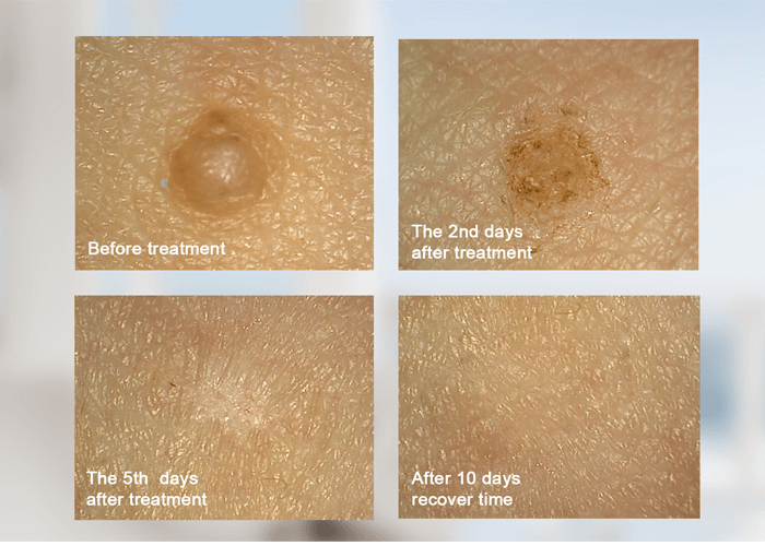 mole dot removal - News - 1