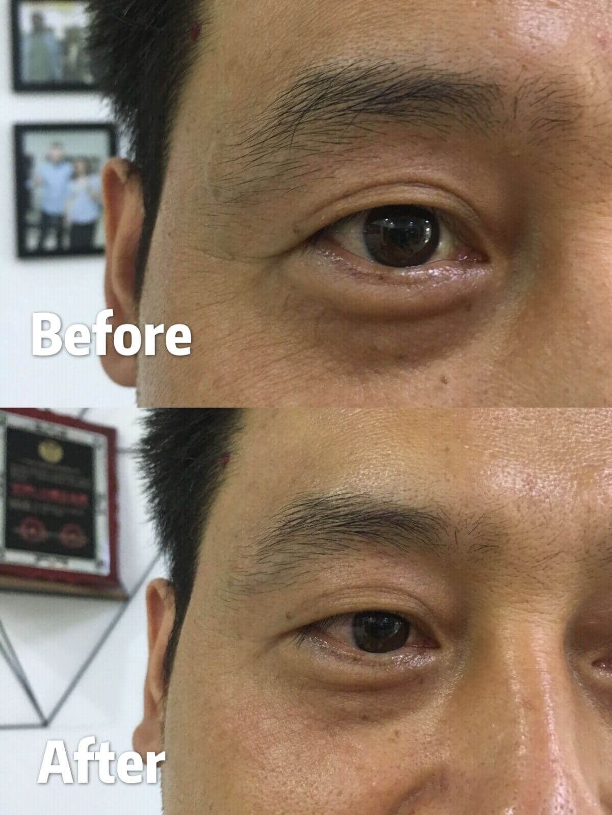 RF eyes machine for beauty salon -  - 6