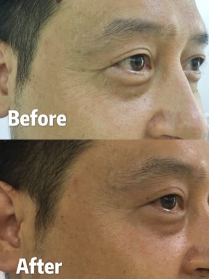 RF eyes wrinkle removal working therapy - News - 3