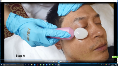 RF eyes wrinkle removal working therapy - News - 2