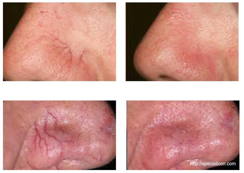 980nm diode spider veins removal laser machine for Vascualr lesions