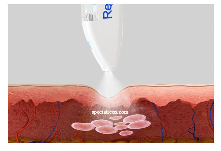 Jet mesogun working area and products - News - 1