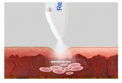 Mesotherapy type anddevelopment history - News - 4