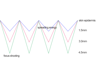 Does 9D HIFU machine effective?