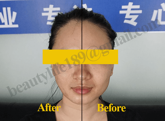 RF lifting machine facial lifting skin tighten beauty 40.68Mhz -  - 11