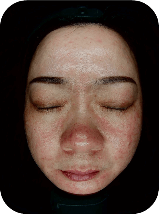 skin analyzer